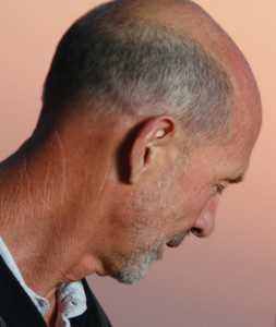 alopeciahombre-problema